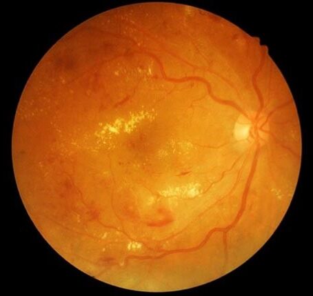 Read more about the article Red Light Therapy for Diabetic Retinopathy